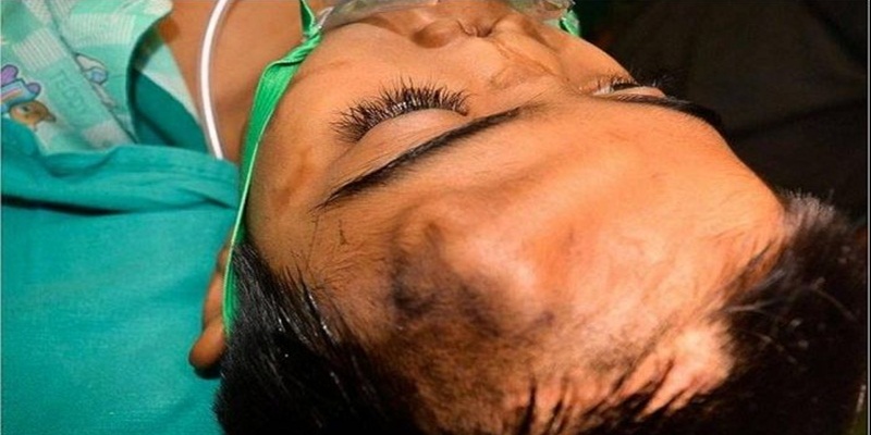 Menino recebe novo nariz que cresceu em sua testa