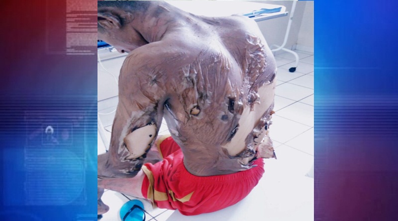 Homem teve 80% do corpo queimado em explosão de barco, diz hospital