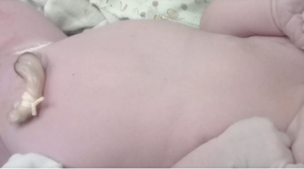 Sem material, médicos usam ligas em umbigos de recém-nascidos no Hospital de Sena Madureira