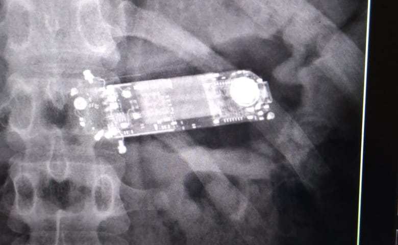 Detento que engoliu celular no presídio de Sena é submetido a cirurgia de emergência