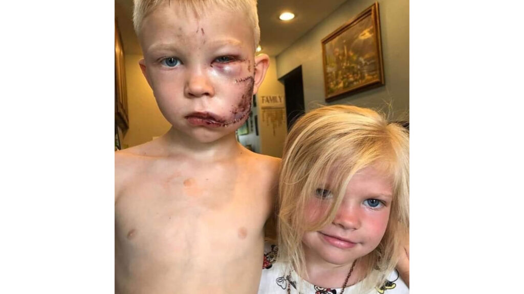 Menino de seis anos salva irmã ao se colocar entre ela e cachorro durante ataque nos EUA