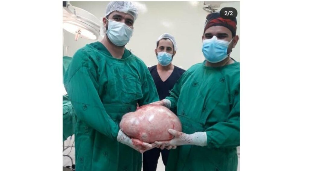 Médicos removem tumor de 20 quilos em ovário de paciente em Cruzeiro do Sul