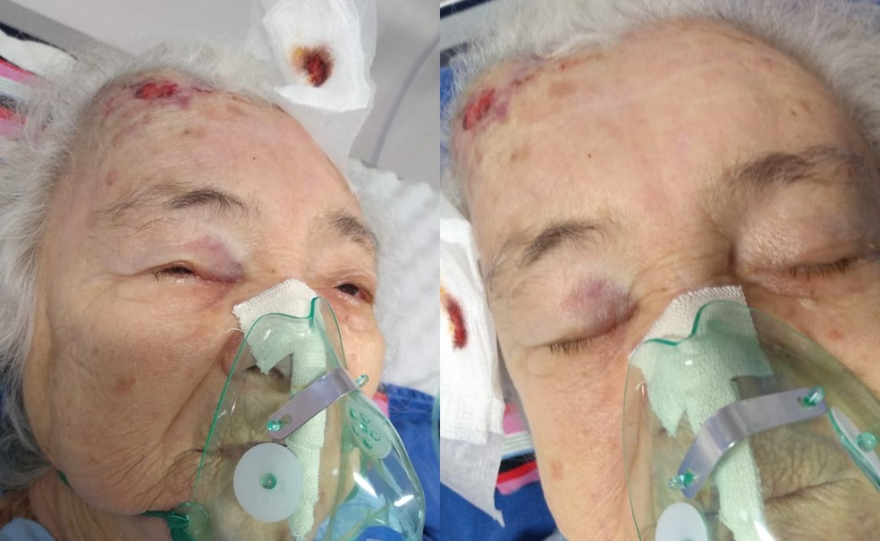 Família denuncia negligência após idosa com Covid-19 cair de leito em hospital de Manaus