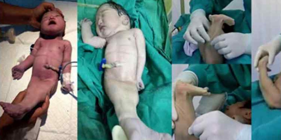 Mãe dá à luz “bebê sereia” e médicos não sabem determinar seu gênero