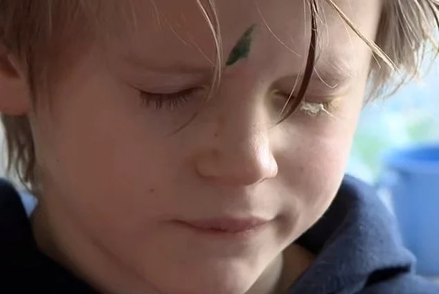 Menino fica quatro dias sem conseguir abrir o olho depois de pai confundir embalagem de supercola com colírio