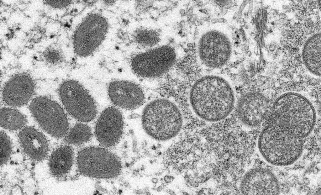 Acre registra o 6º caso suspeito de variola dos macacos, informa a Sesacre