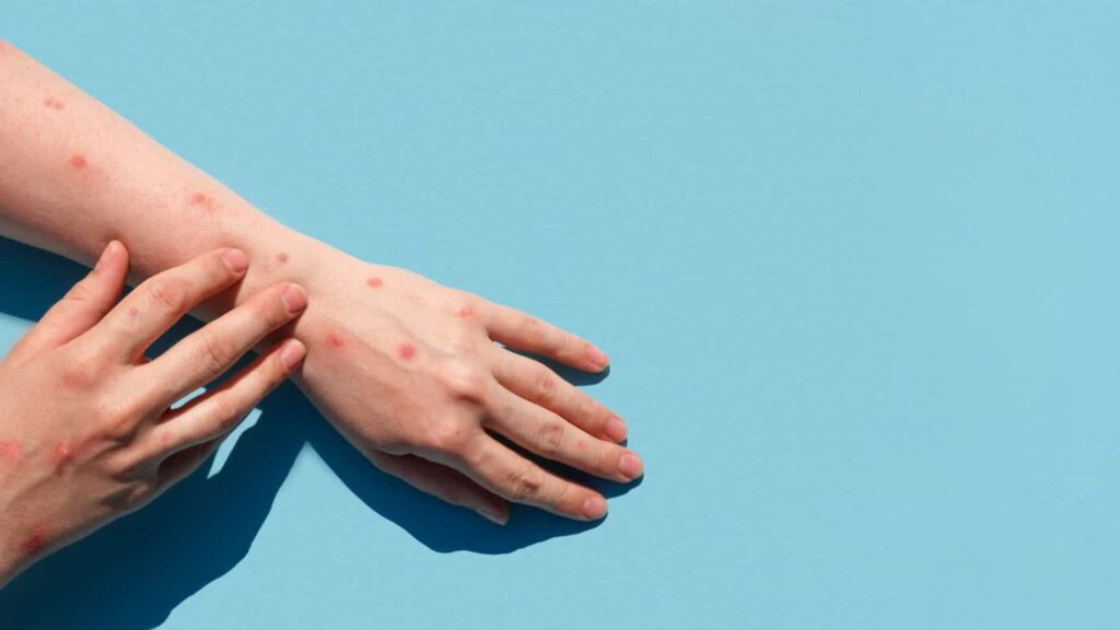 Brasil recebe primeiras doses de vacinas contra a varíola dos macacos