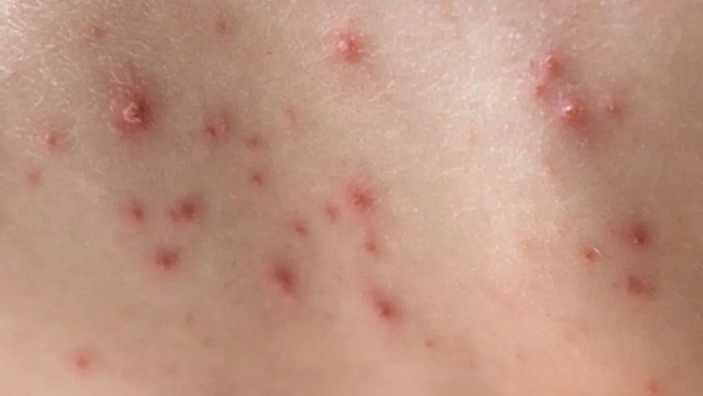 Vacina contra catapora tem estoque zerado no AC: ‘Desabastecimento nacional’, diz PNI