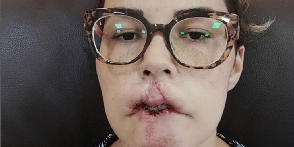 Mulher perde lábio após preenchimento de PMMA: “Raiva”