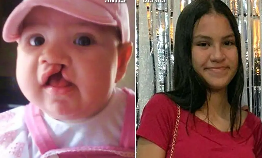 “Mudou a história da minha filha”, diz mãe de paciente com lábio leporino tratada no Acre
