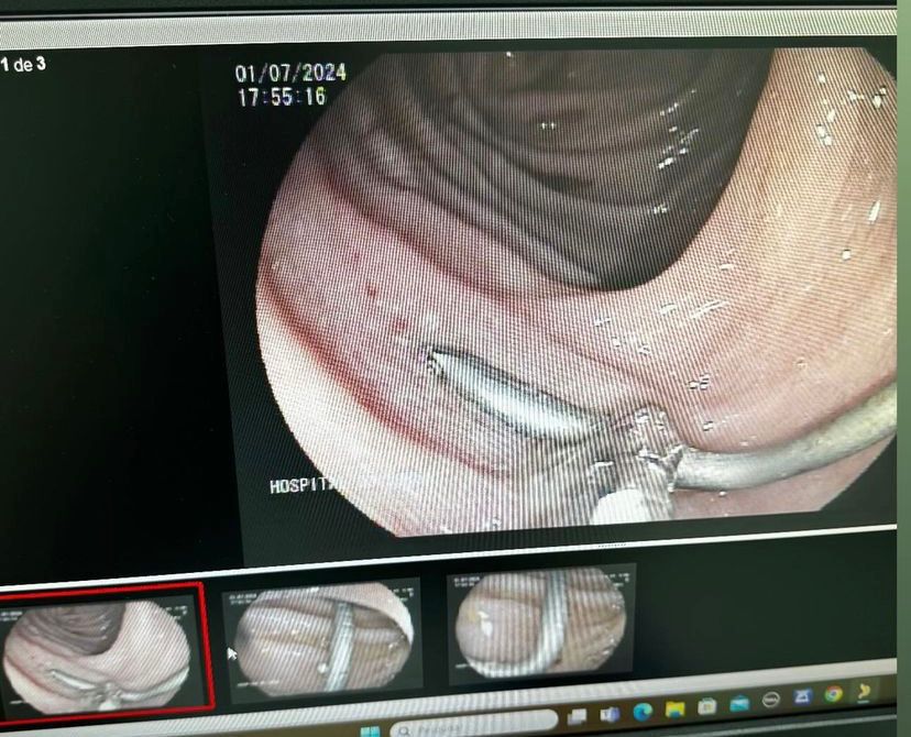 Criança de 3 anos é atendida no Hospital do Juruá após engolir prego