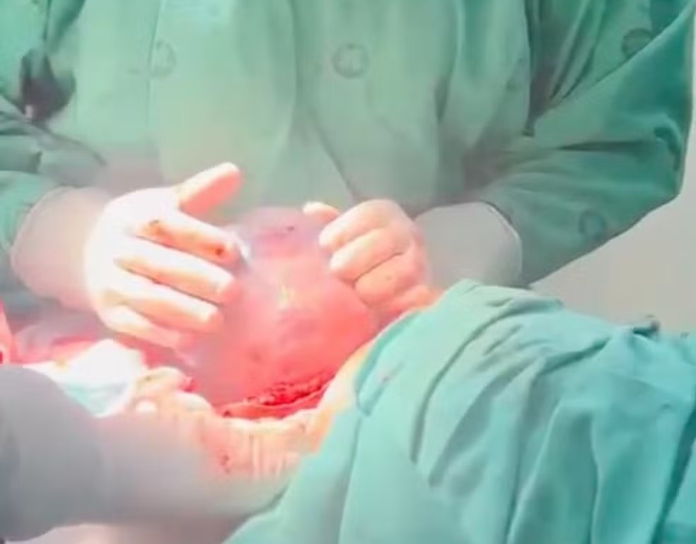 Bebê nasce empelicado e momento é registrado no Acre: ‘Alegrou nossa noite’, diz médico