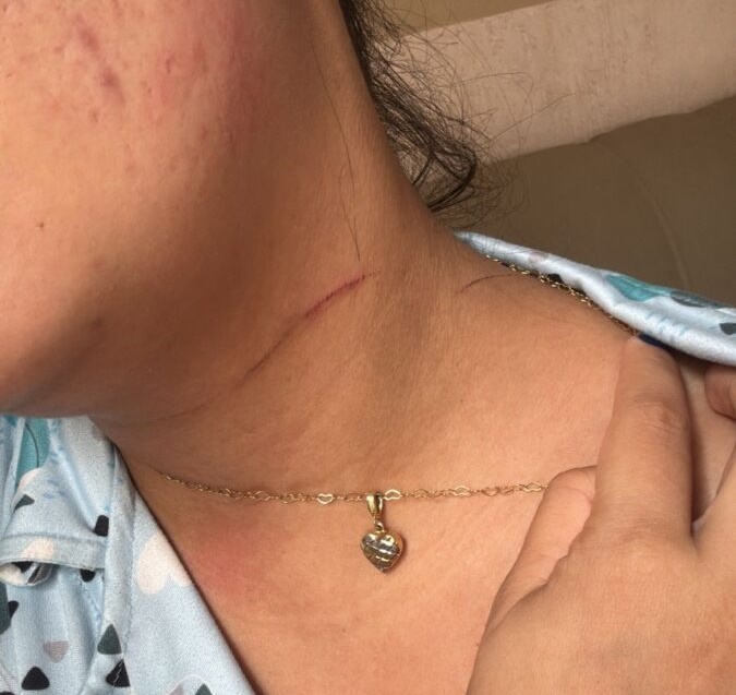 Linha de pipa com cerol quase degola biomédica no Acre enquanto ela dirigia