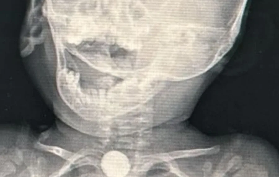 Em Cruzeiro do Sul, bebê indígena de 1 ano é hospitalizado após engolir bateria de brinquedo