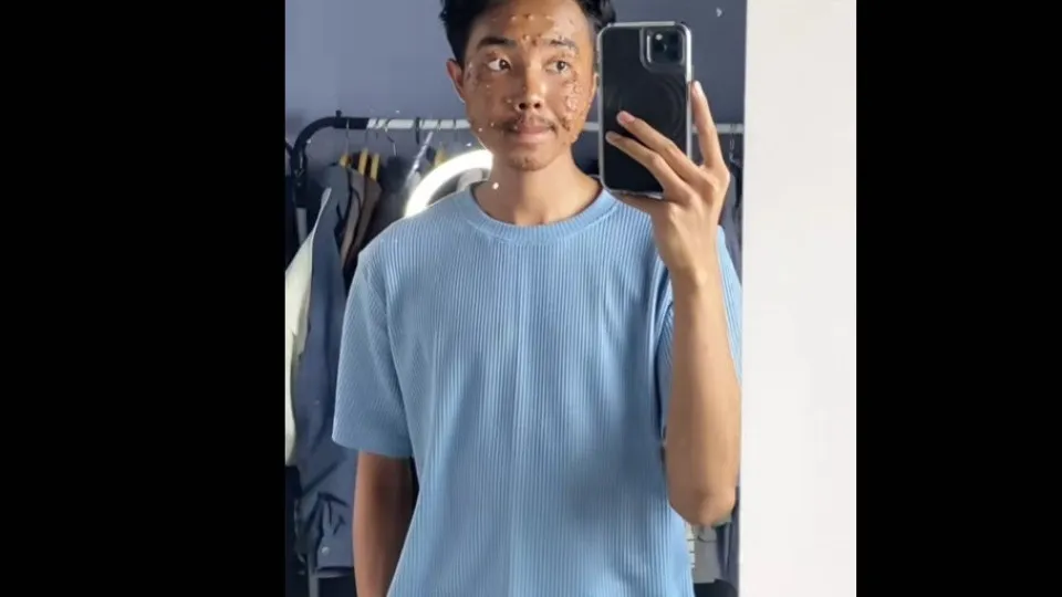 Homem contrai infecção viral após usar roupa de brechó sem lavar