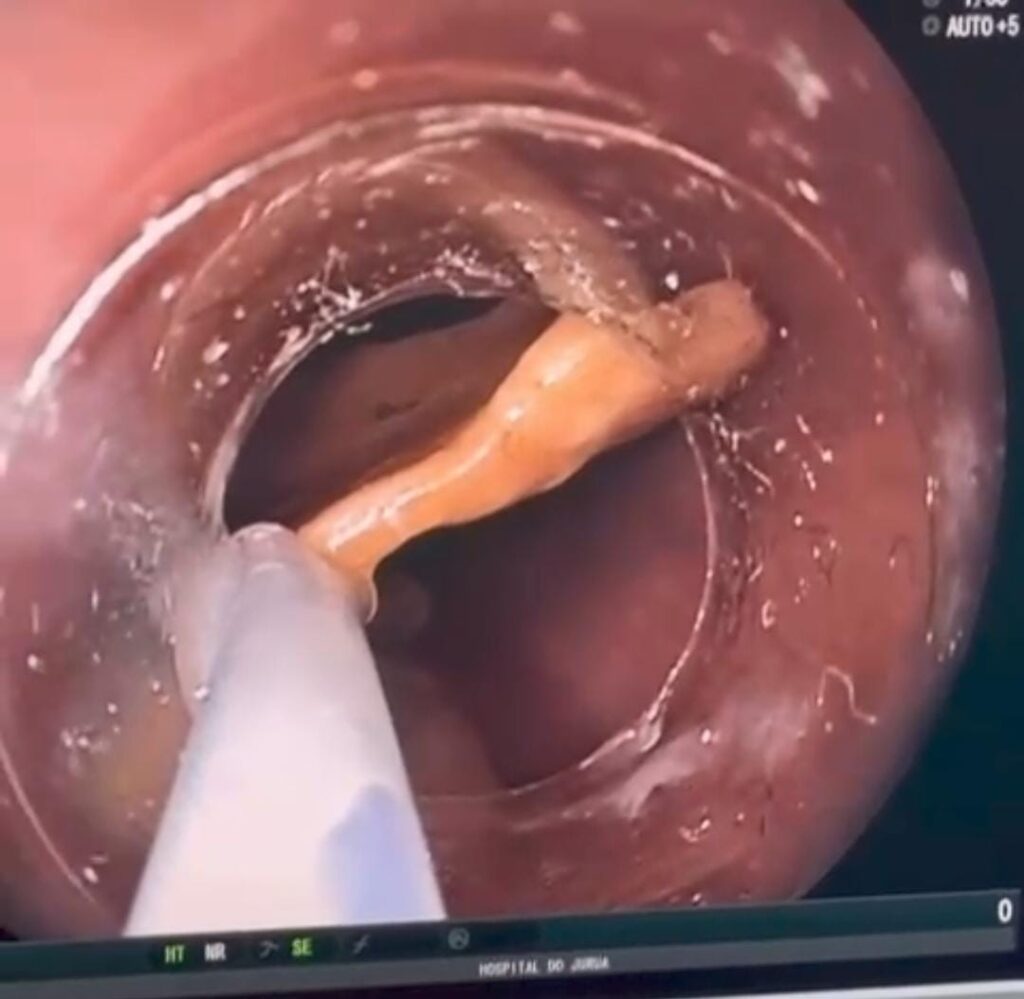 Homem de 25 anos passa por endoscopia de urgência para retirada de prótese dentária no Hospital do Juruá; ASSISTA