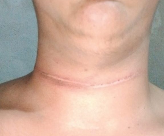 Motociclista tem linha de pipa presa ao pescoço em avenida de Cruzeiro do Sul