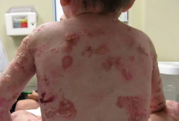 Entenda o que é a Epidermólise Bolhosa, doença rara investigada no caso da bebê em Cruzeiro do Sul