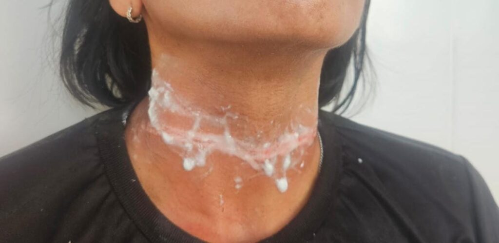 Em Cruzeiro do Sul, mulher tem pescoço marcado por fio em acidente de moto