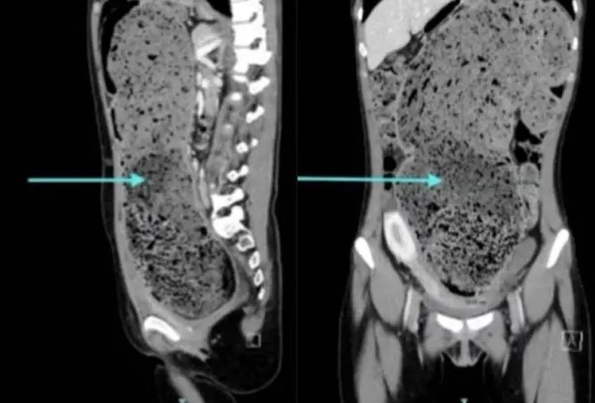 Mulher passa quatro meses constipada e perde 4,5 quilos após fazer cocô