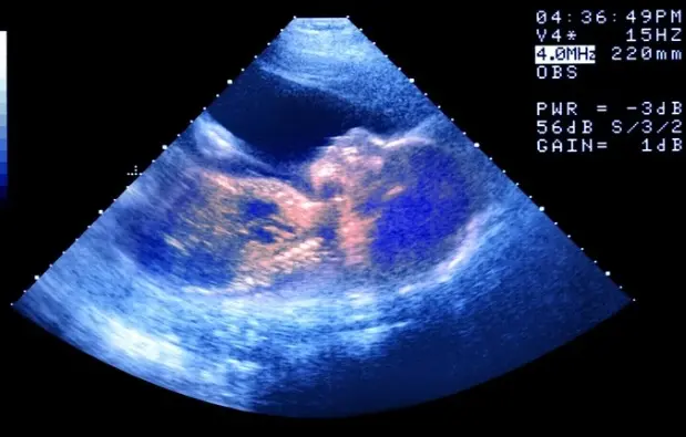 Bebê nasce de embrião congelado há 30 anos e bate recorde mundial