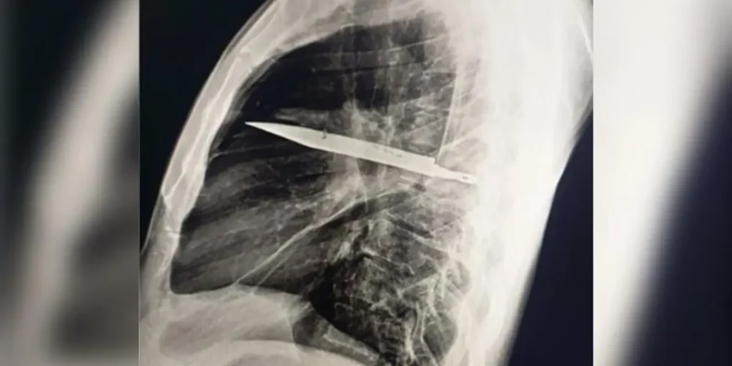 Homem sente dor no peito e descobre faca alojada no corpo há oito anos