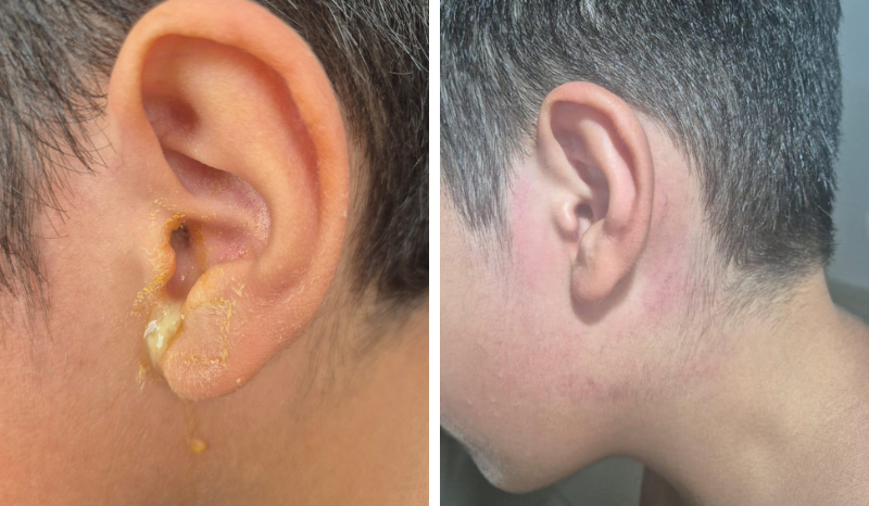 Covardia: Criança é agredida com tapas na orelha por morador de condomínio e acaba com o tímpano perfurado