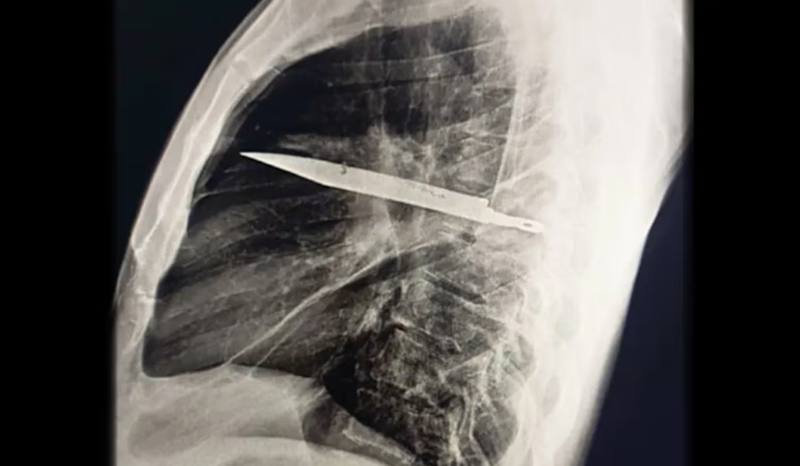 Com pus escorrendo do peito, homem descobre faca presa no tórax por 8 anos