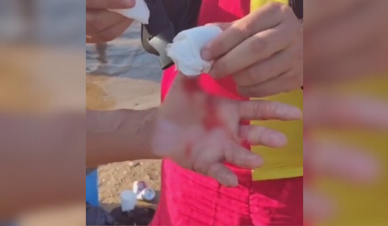 VÍDEOS: ataques de ‘piranhas’ em balneário deixam banhistas feridos