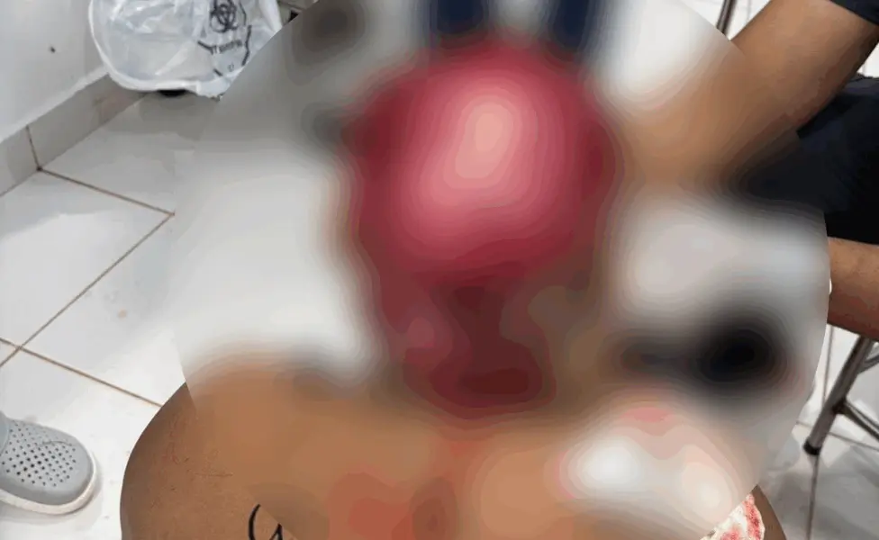 Jovem indígena tem couro cabeludo arrancado ao operar draga no Rio Acre