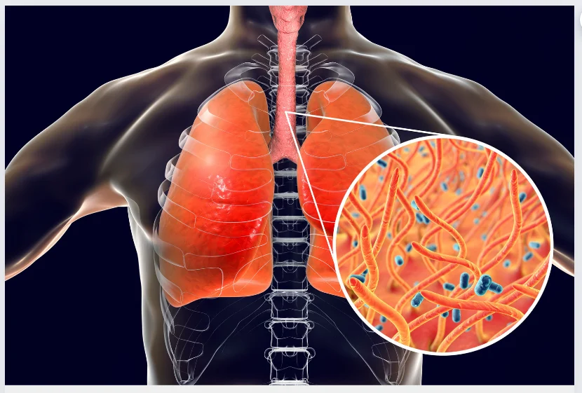 Município do Acre acende alerta após aumento de casos de coqueluche e reforça vacinação