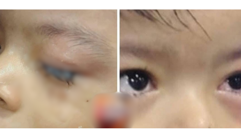 Criança tem olhos colados por cola industrial e mobiliza hospital