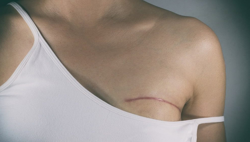 Paciente que teve mama retirada após diagnóstico errado de câncer será indenizada em R$ 40 mil no Acre