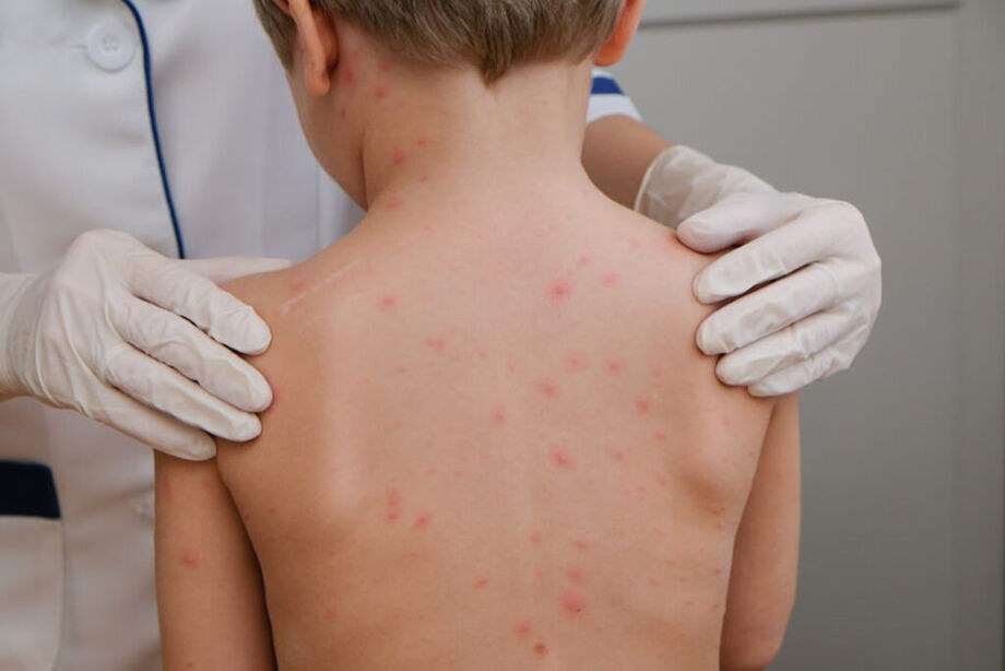 Cruzeiro do Sul registra 6 dos 10 casos de meningite no Acre em 2026
