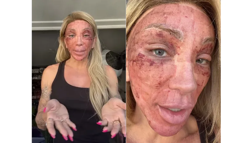 Maya Massafera mostra inflamação no rosto após peeling: “Não consigo rir”